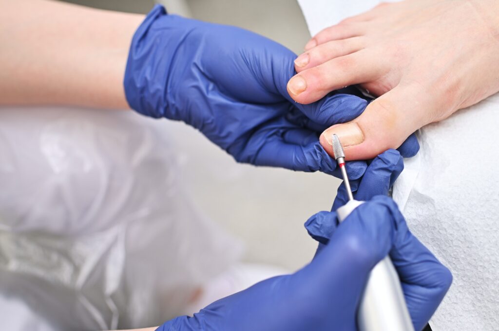 Hardware medical pedicure with a drill and nail files. A patient on a pedicure with a podiatrist